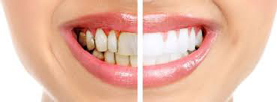 Çürük Diş Belirtileri ve Tedavisi