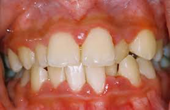 Diş Eti Ağrısı Belirtileri ve Tedavisi