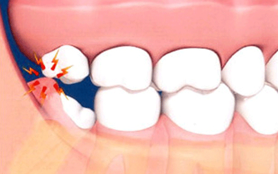 Diş Kökü Özellikleri ve Faydaları Nelerdir?