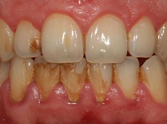 Diş Tartarı Kullanımı ve Faydaları Nelerdir?
