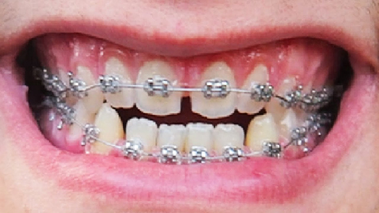 Diş Teli Özellikleri ve Faydaları Nelerdir?